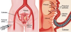 uterine-fibroids